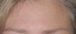 Brow Lift After