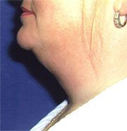 Aging Neck Before