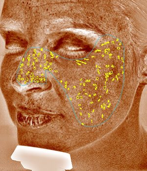 Brown Spots | VISIA Skin Analysis 
