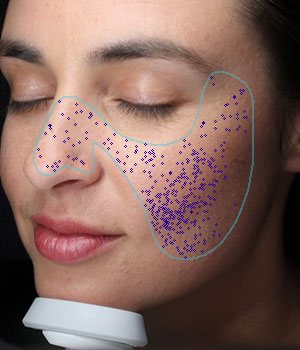 Pores | VISIA Skin Analysis 
