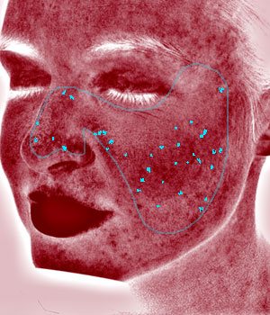 Red Areas | VISIA Skin Analysis 